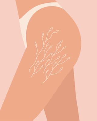 Everything you need to know about stretch marks